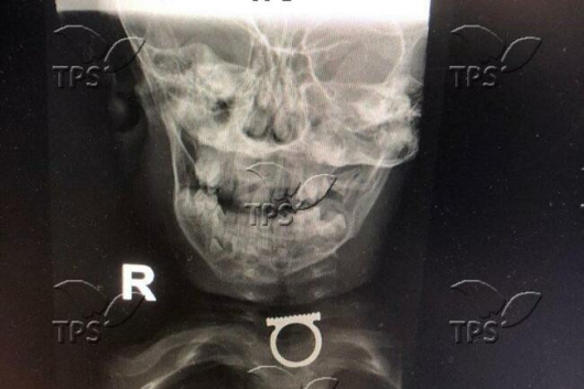 Лекари от ерусалимския медицински център Шаарей Зедек извадиха пръстен, заседнал