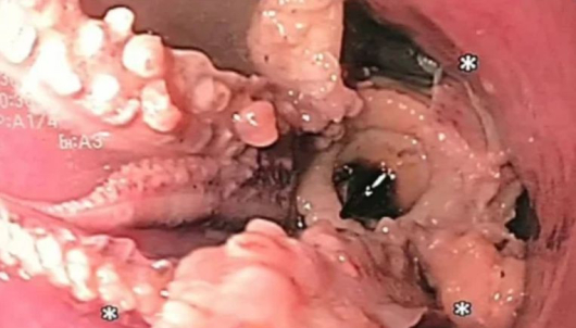 В Сингапур лекари извадиха цял октопод от хранопровода на пациент