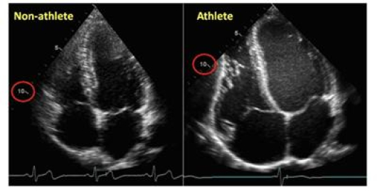 СРАВНЕНИЕ: Ехографски образи на сърцето на здрав човек, който не спортува активно (вляво), и на атлет.